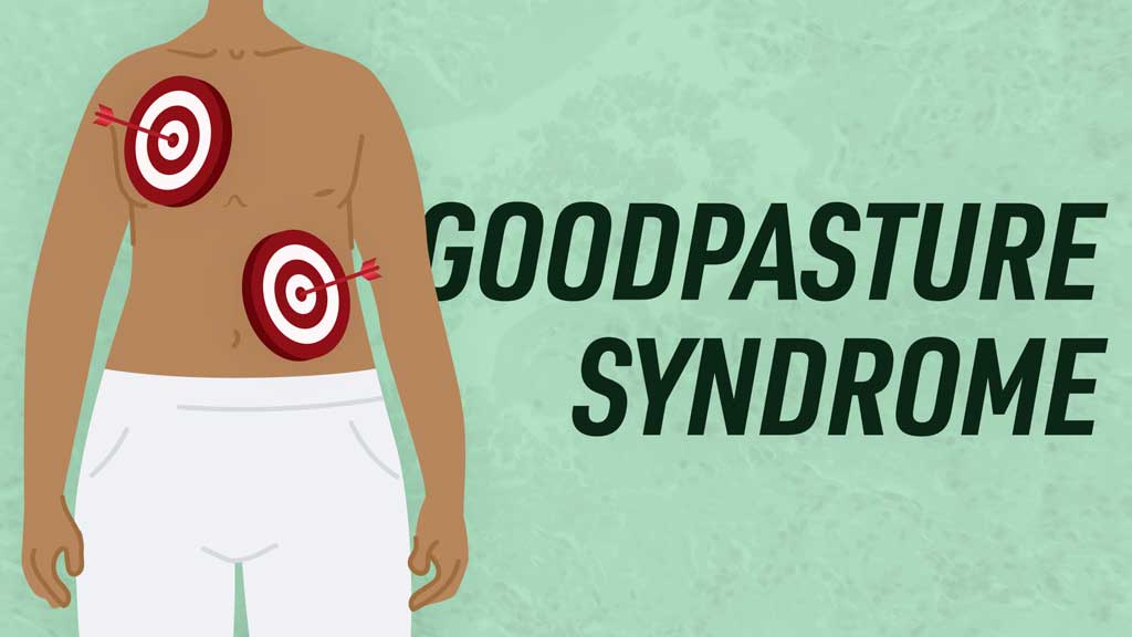 Cover image for: Goodpasture Syndrome